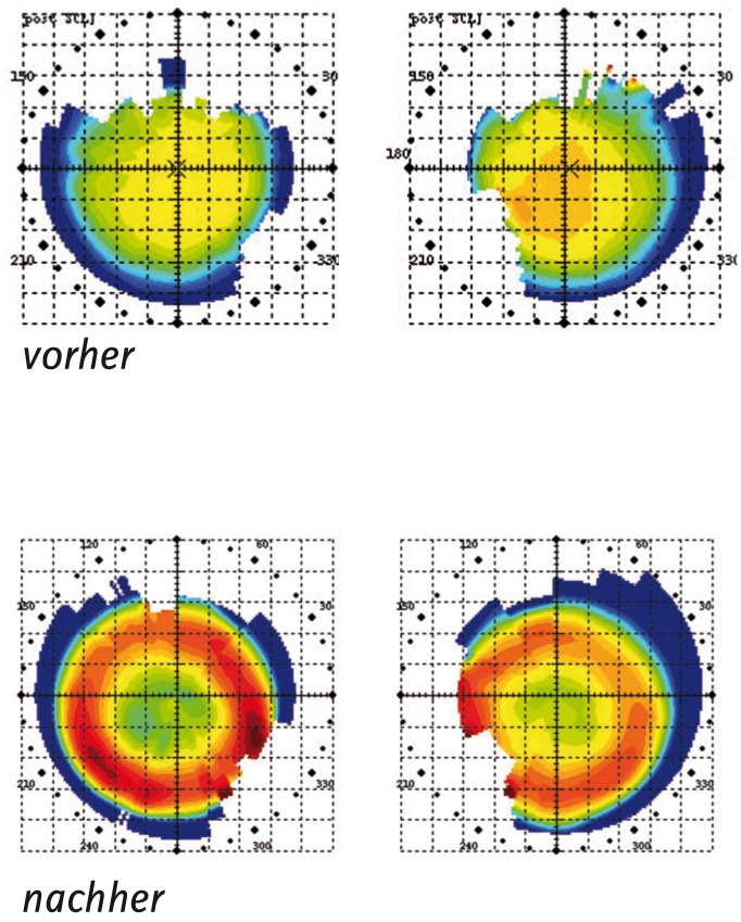 Kontaktlinsen Gleiche Stärke Wie Brille